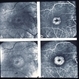 Chloroquine Toxicity